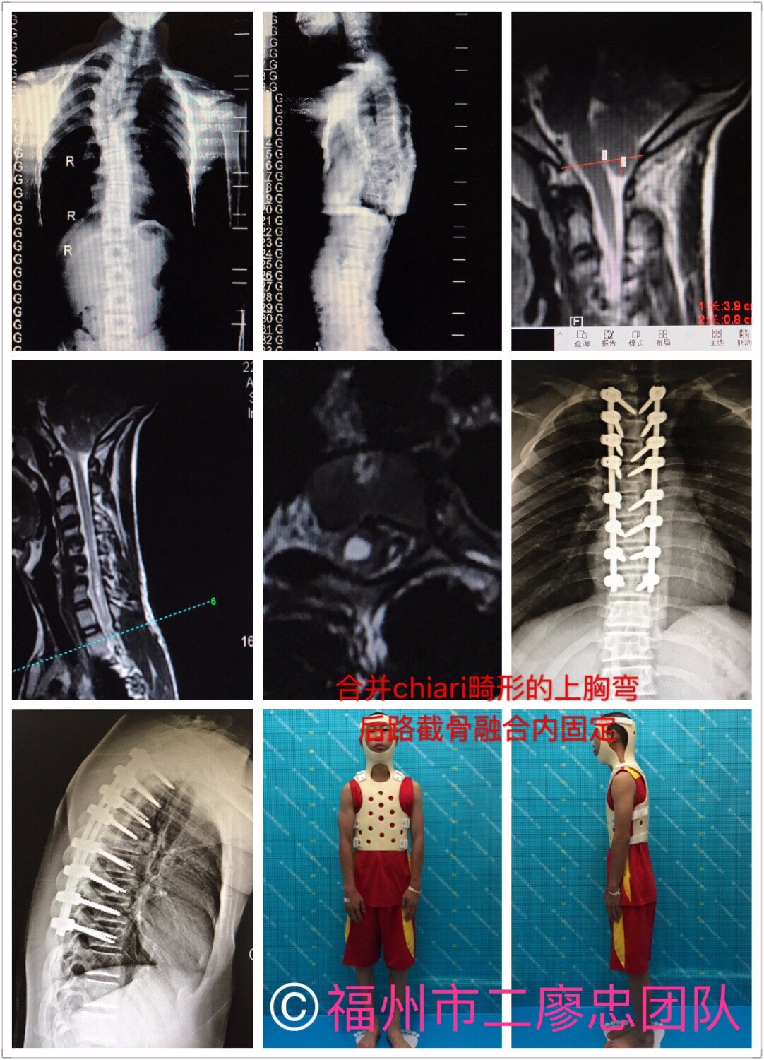 杭州市萧山区中医院再次成功挑战脊柱畸形高难度手术-医院汇-丁香园