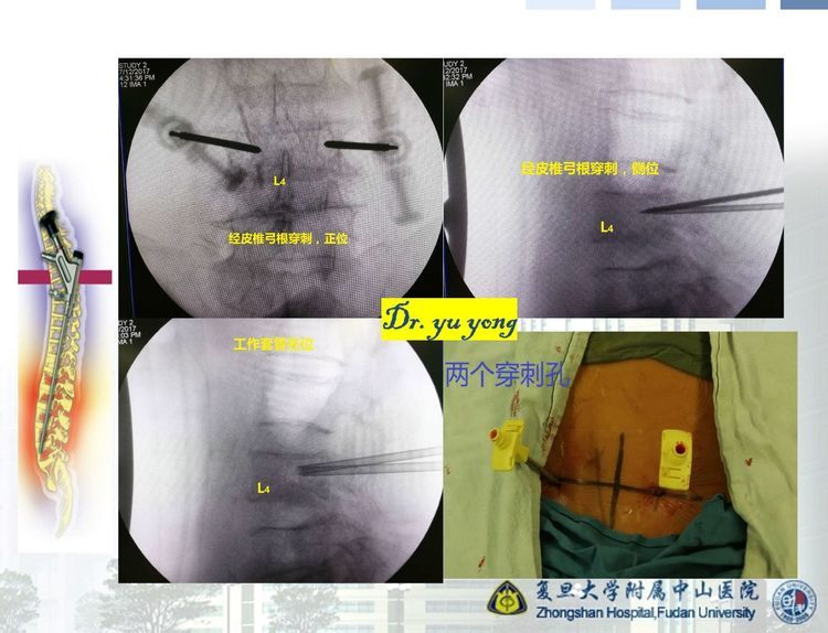 腰椎系列二壓縮性骨折的微創治療醫學是什麼