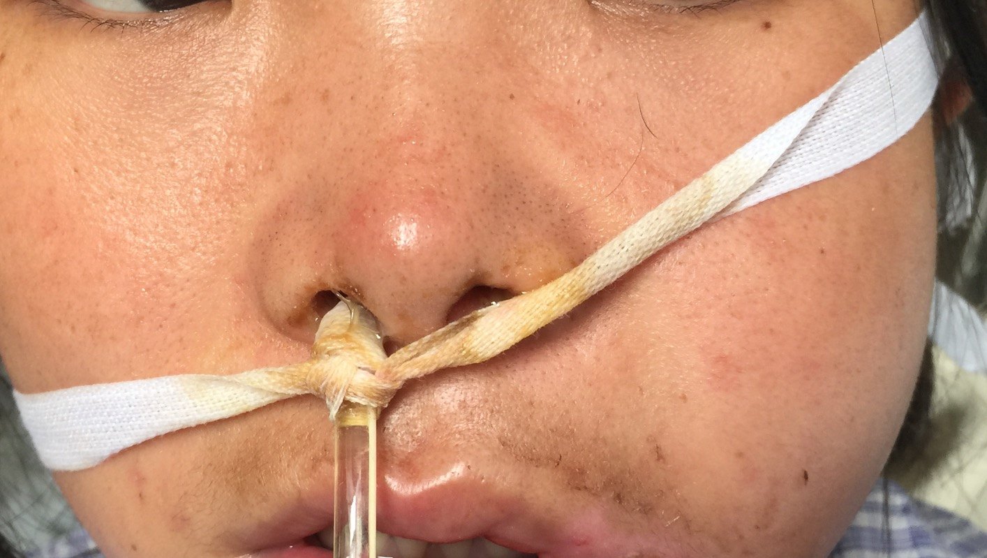 内镜辅助经鼻,经口颅底软骨肉瘤切除皮瓣重建,面部无痕 