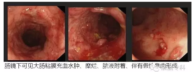 升结肠炎的症状及图片图片