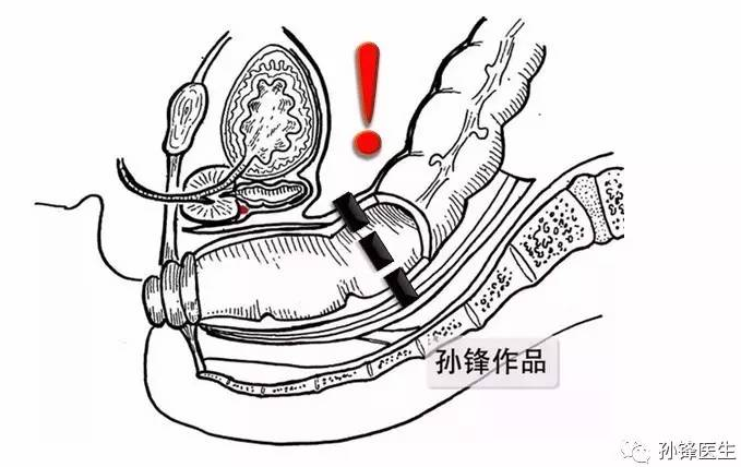 直肠癌吻合口瘘图片图片