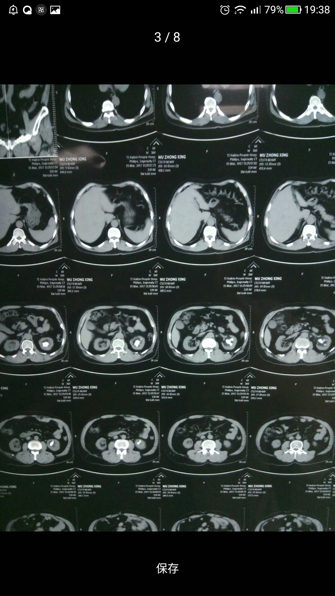 完全鹿角樣結石,充滿腎盂腎盞.