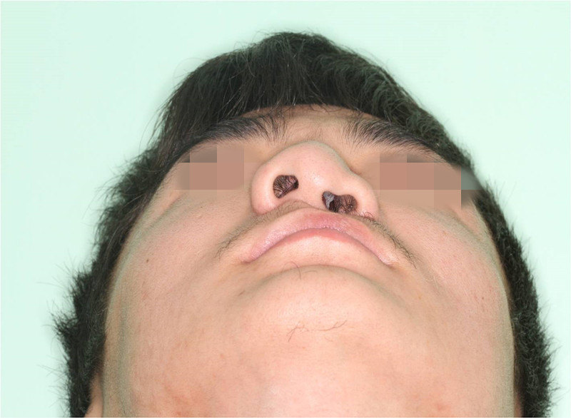 唇裂鼻畸形整复术后效果(术后6个月) 