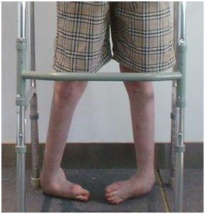 马蹄内翻足 - 好大夫在线