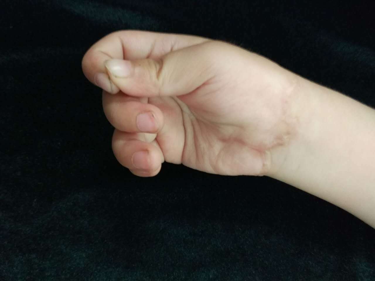 无出现坏死感染情况,而且还可轻微屈伸,预示着小女孩的断掌再植成功