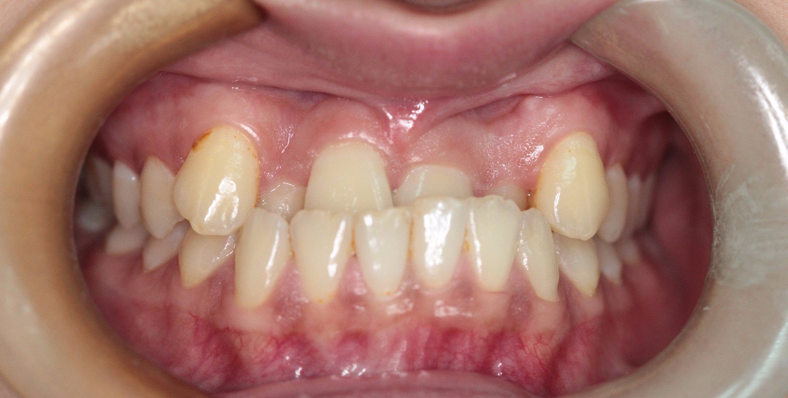 原创 地包天患者矫治前后