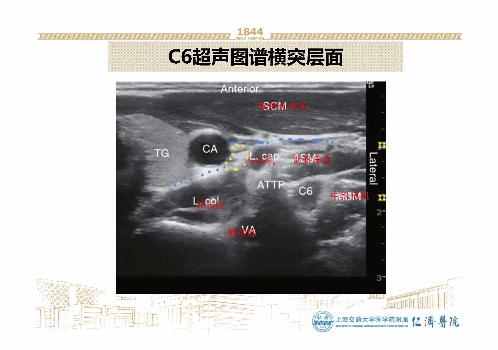 超声引导星状神经节阻滞