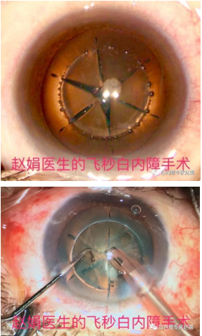 超声乳化白内障手术是用手术刀制作一个很小的角膜切口,用手术镊子将