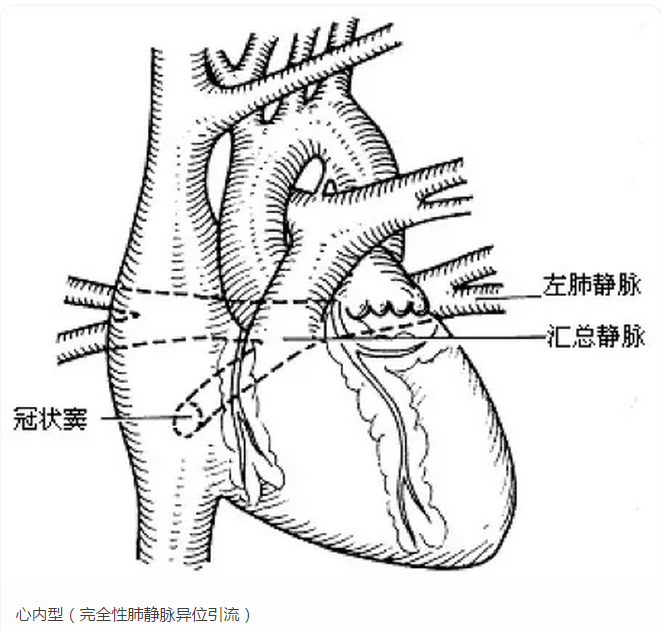 根据肺静脉引流的位置,完全性肺静脉异位引流分为四种类型:心上型,心