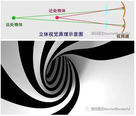 疲勞的目的,斜視矯正之後,患者的代償頭位能夠自然恢復正常或得到改善