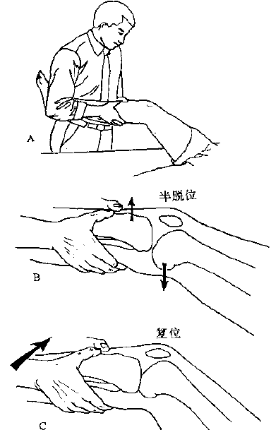 体格检查膝关节轴移试验判断自己是不是前交叉韧带损伤