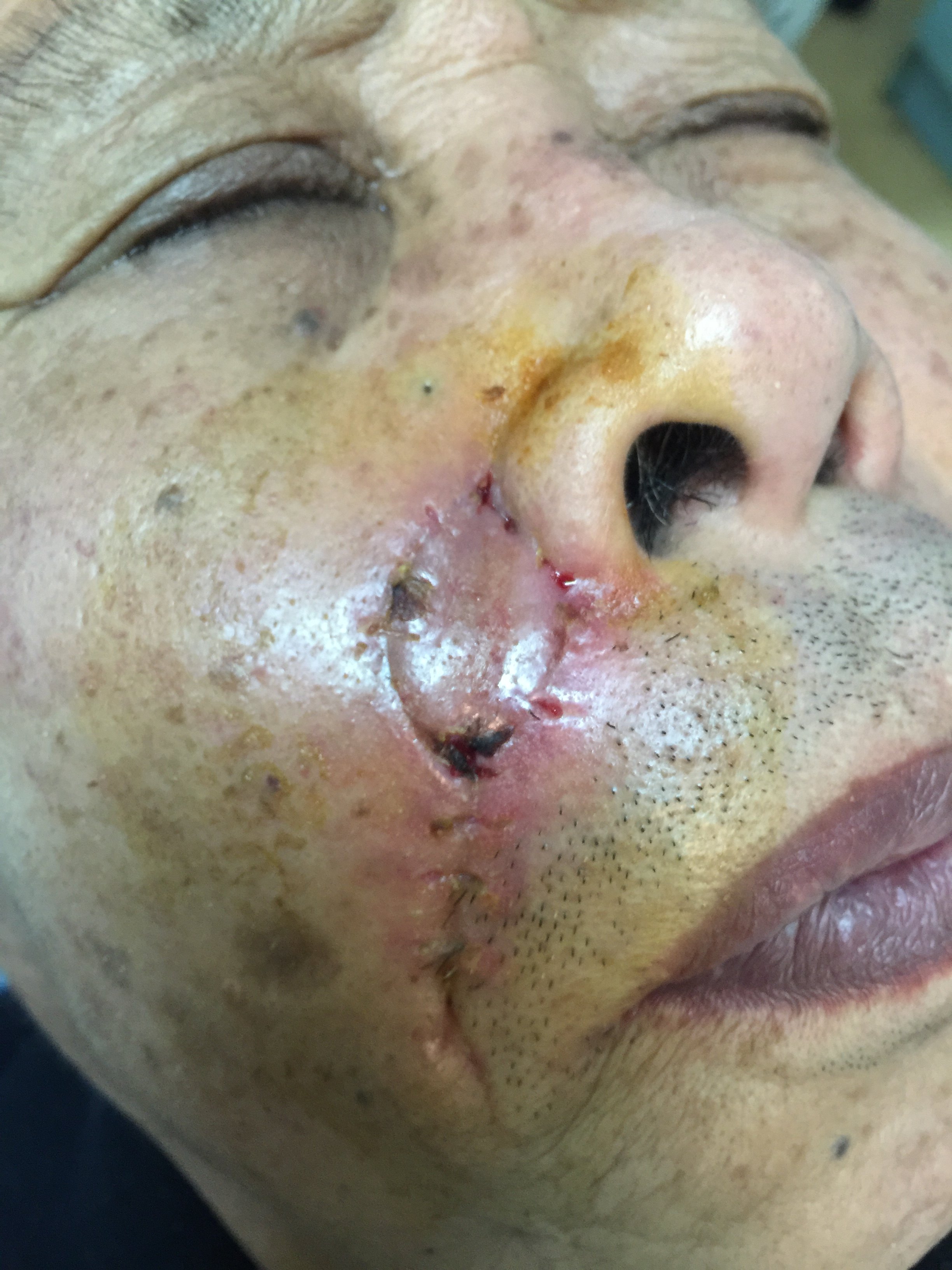 颌面部色素肿物切除后的修复