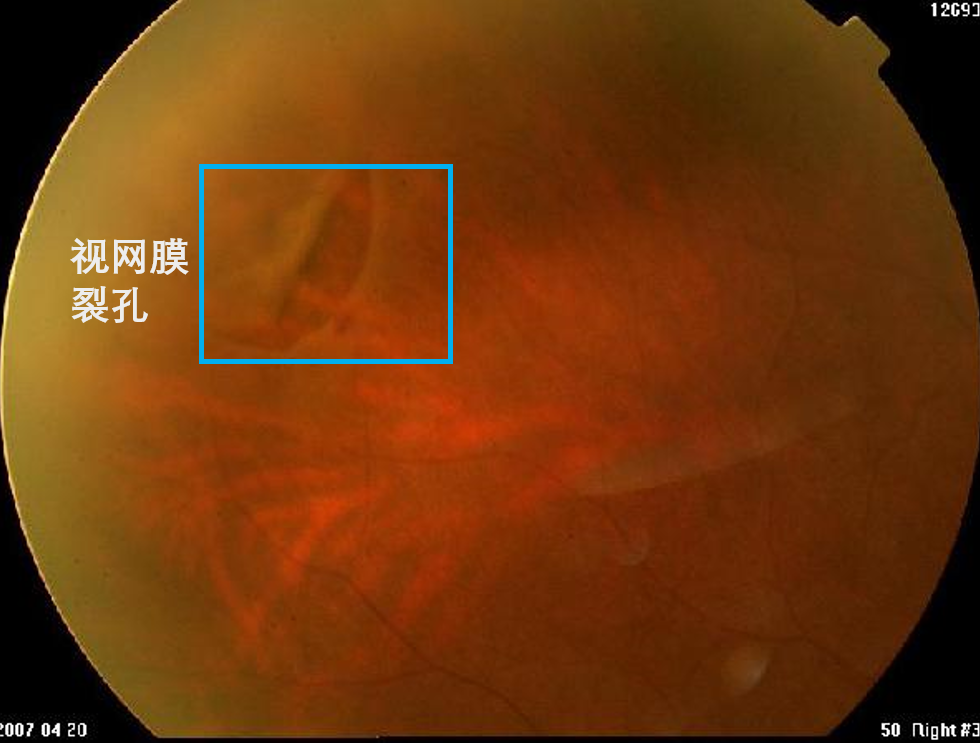 视网膜裂孔的临床表现及防治