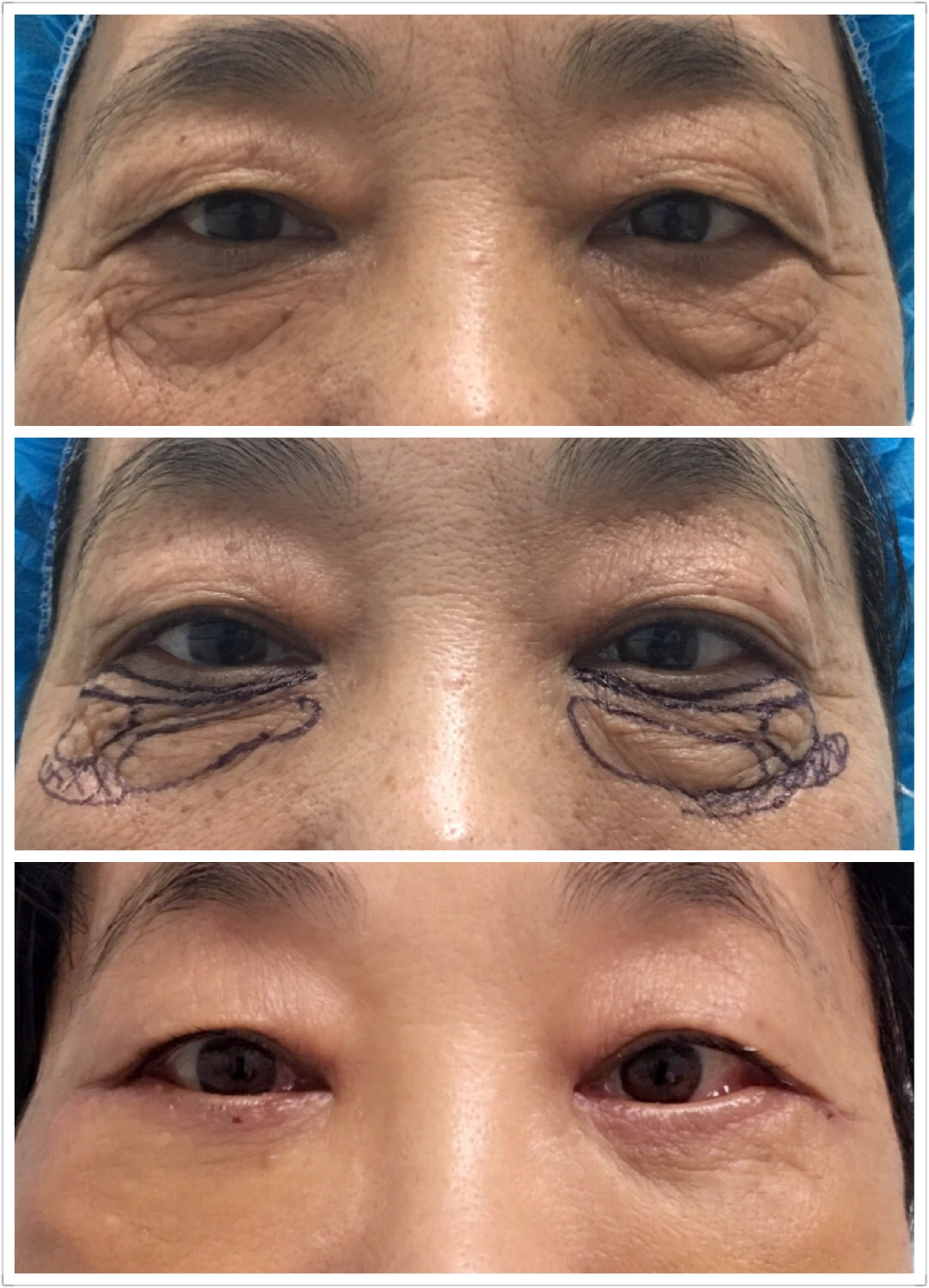 严重眼袋,下睑皮肤松弛,皱褶一例!