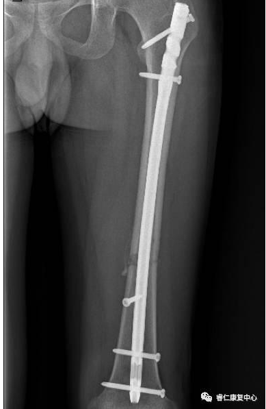 胡大教授讲解大腿骨折术后功能锻炼