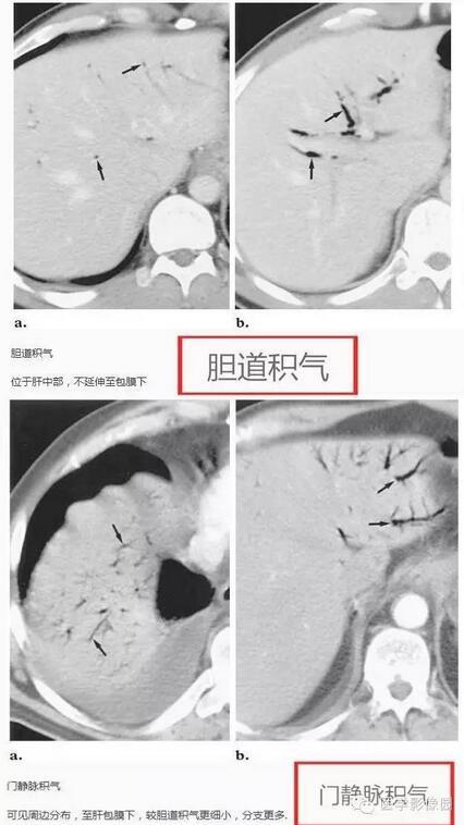 門靜脈積氣與膽管內積氣的鑑別:由於門靜脈血流為離肝門方向,血流將