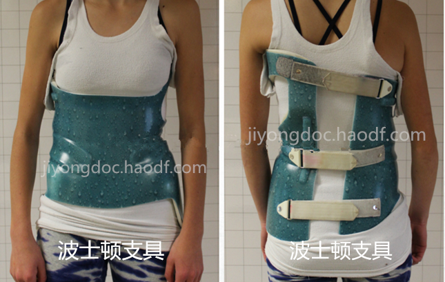 脊柱侧弯矫正支具有哪些?(连载二)