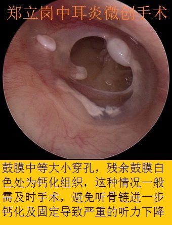 慢性化脓性中耳炎耳内镜微创手术第447广东佛