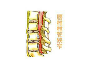 腰腿疼痛不止是腰椎间盘突出症 也可能是它 腰腿痛 腰腿痛病因