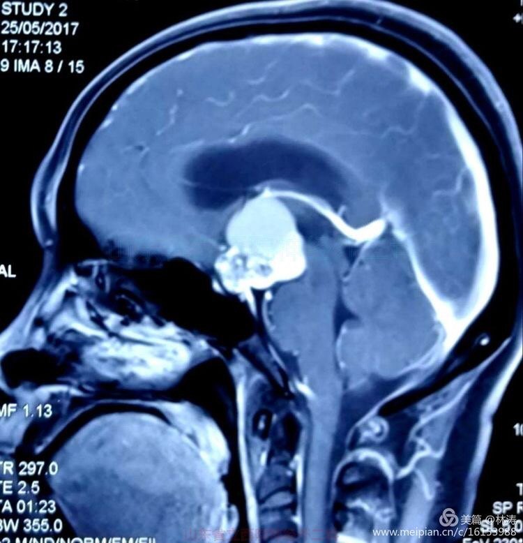 全切巨大钙化颅咽管瘤