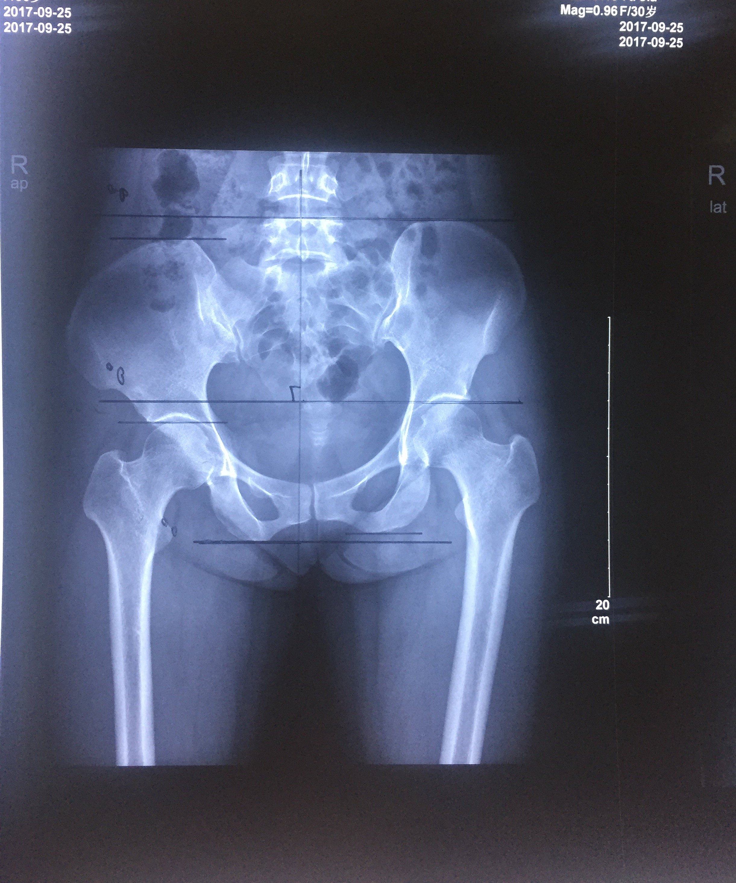 患者非常痛苦x光片提示:骨盆平衡失调,右侧髂骨前旋,导致右侧腿长分析