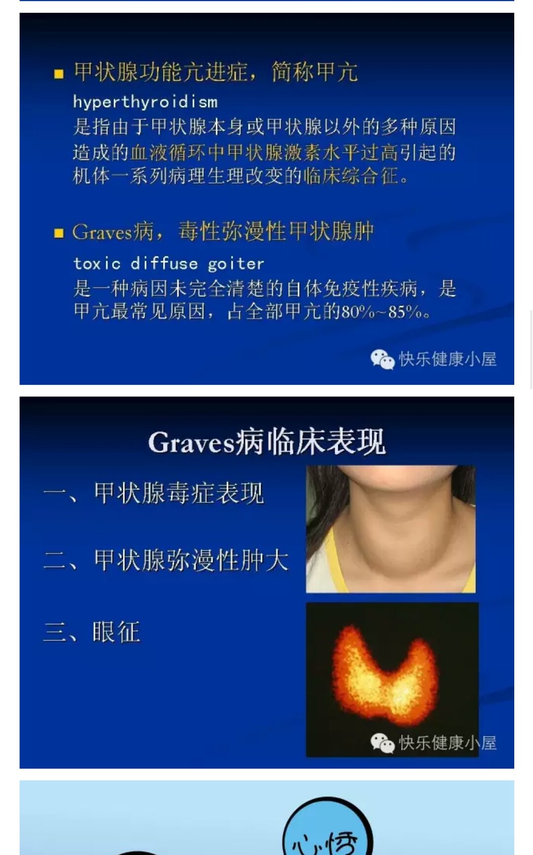 甲亢碘131治疗 - 好大夫在线