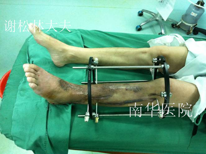 小腿严重毁损离断再植 - 好大夫在线