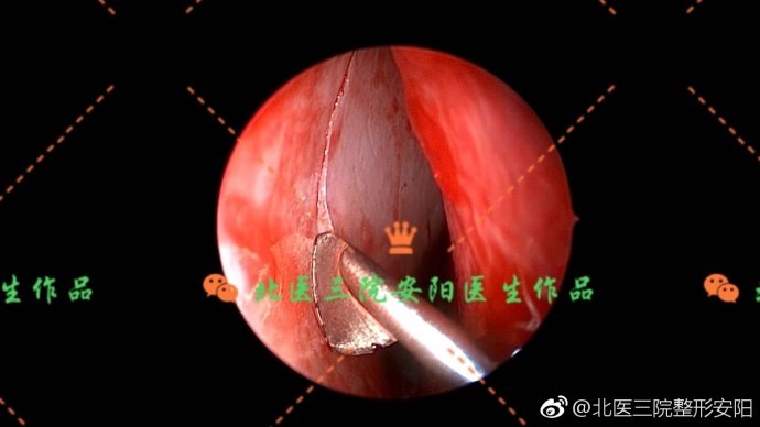 内窥镜下矫正鼻中隔偏曲联合鼻综合术