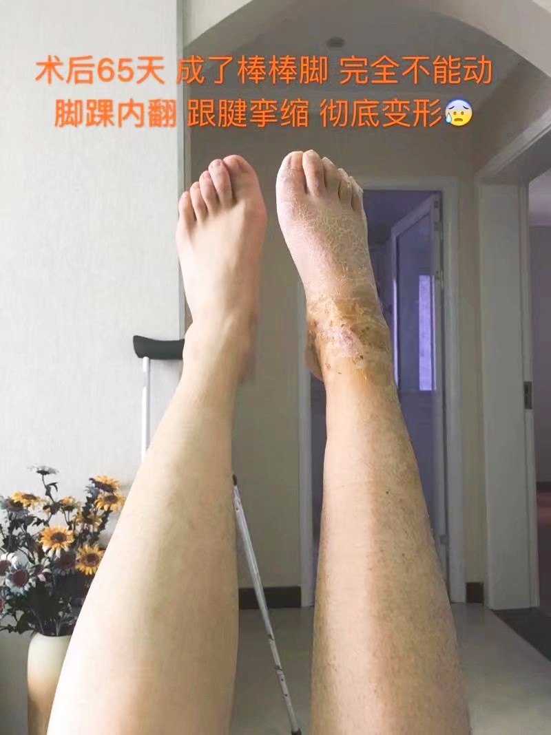 医生说虽然我骨头长得好,但是 关节粘连 ,肌肉萎缩,跟腱挛缩了,再不