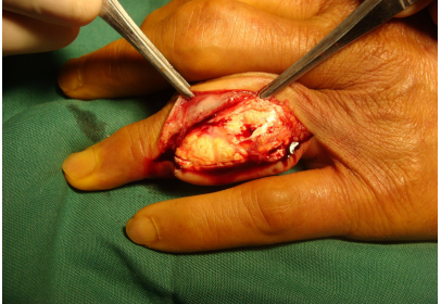 痛风_疾病介绍_治疗方法_介绍_治疗方式 - 好大夫在线