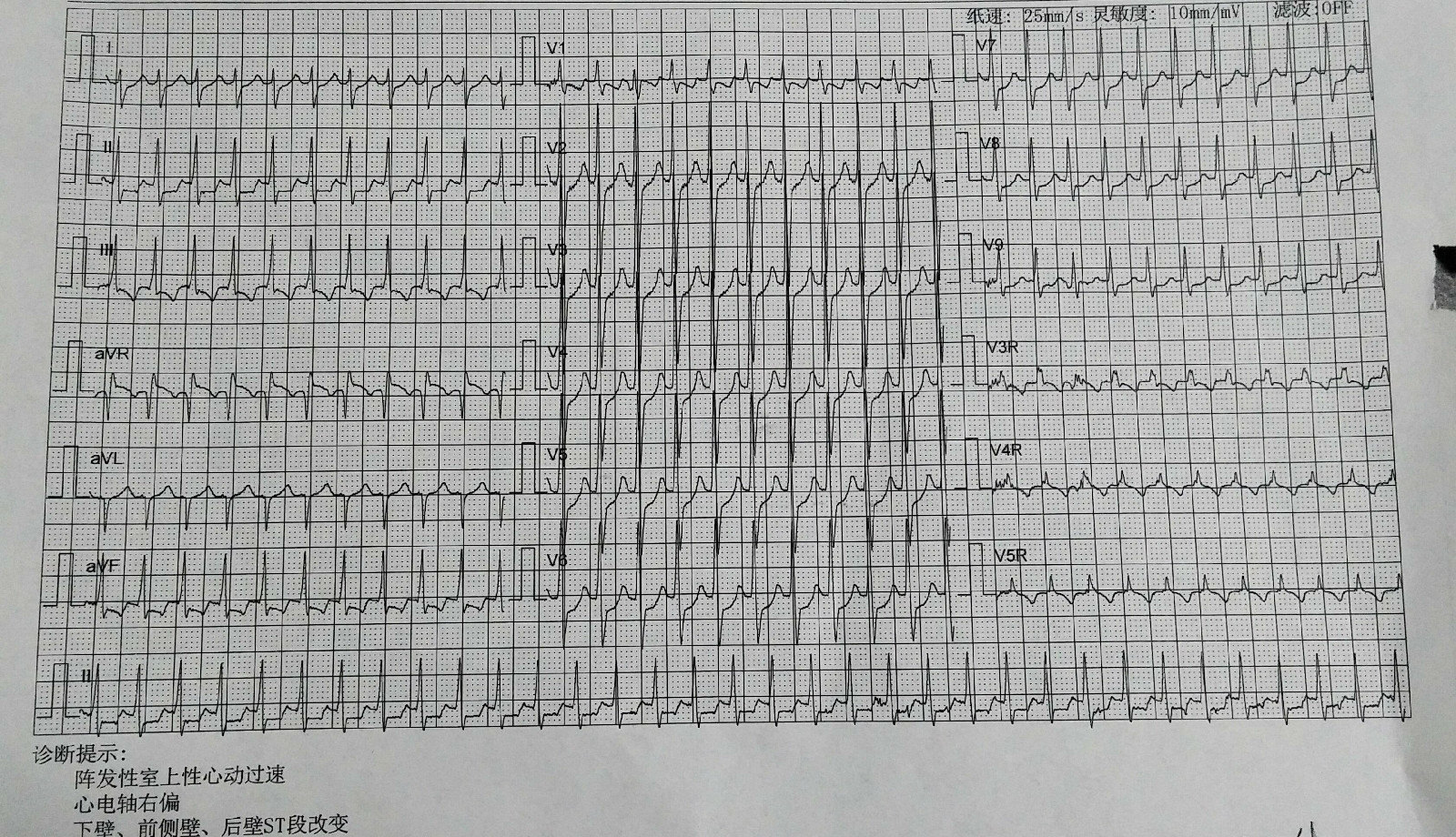 阵发性心动过速图片