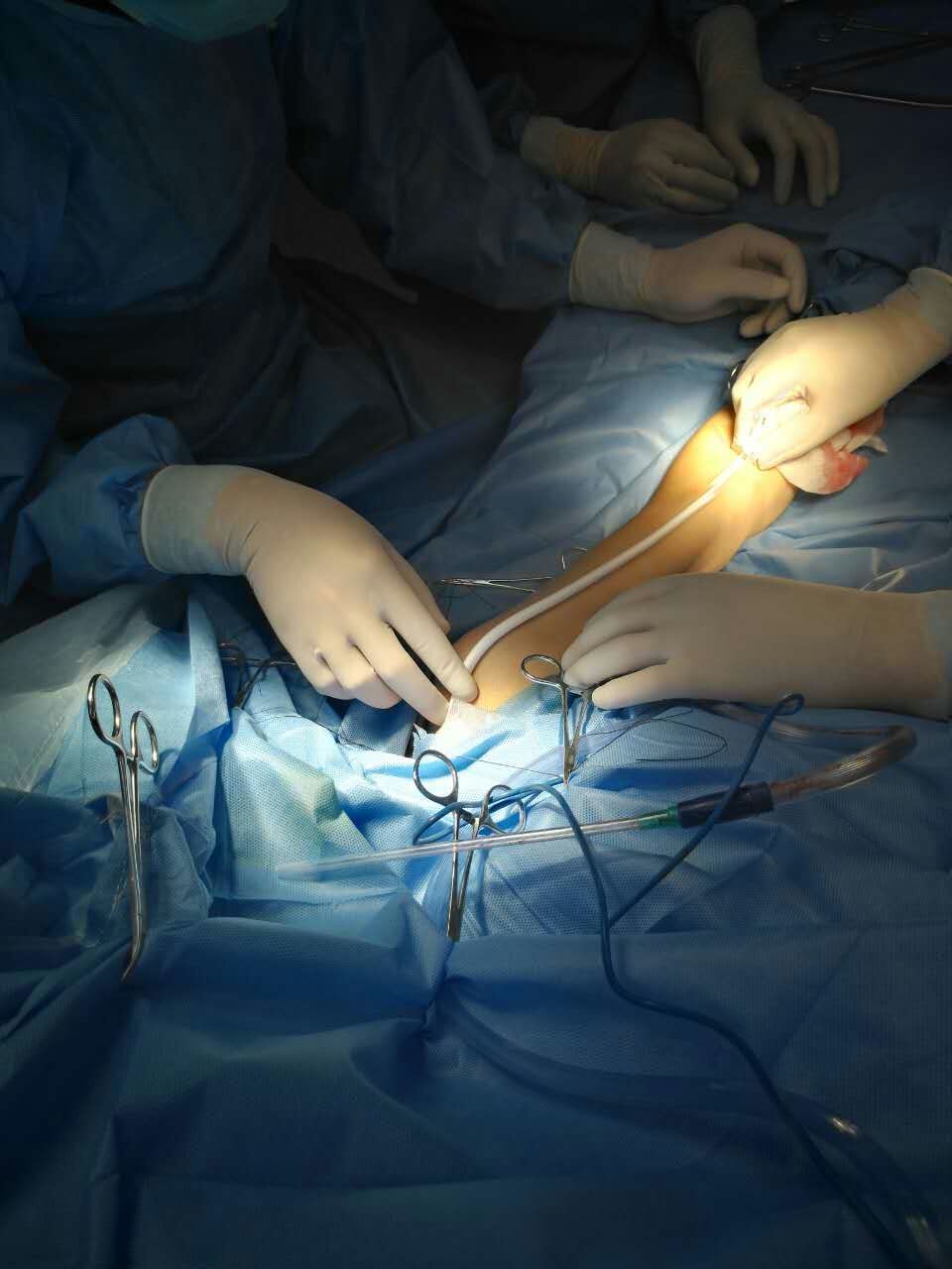 人工血管透析通路