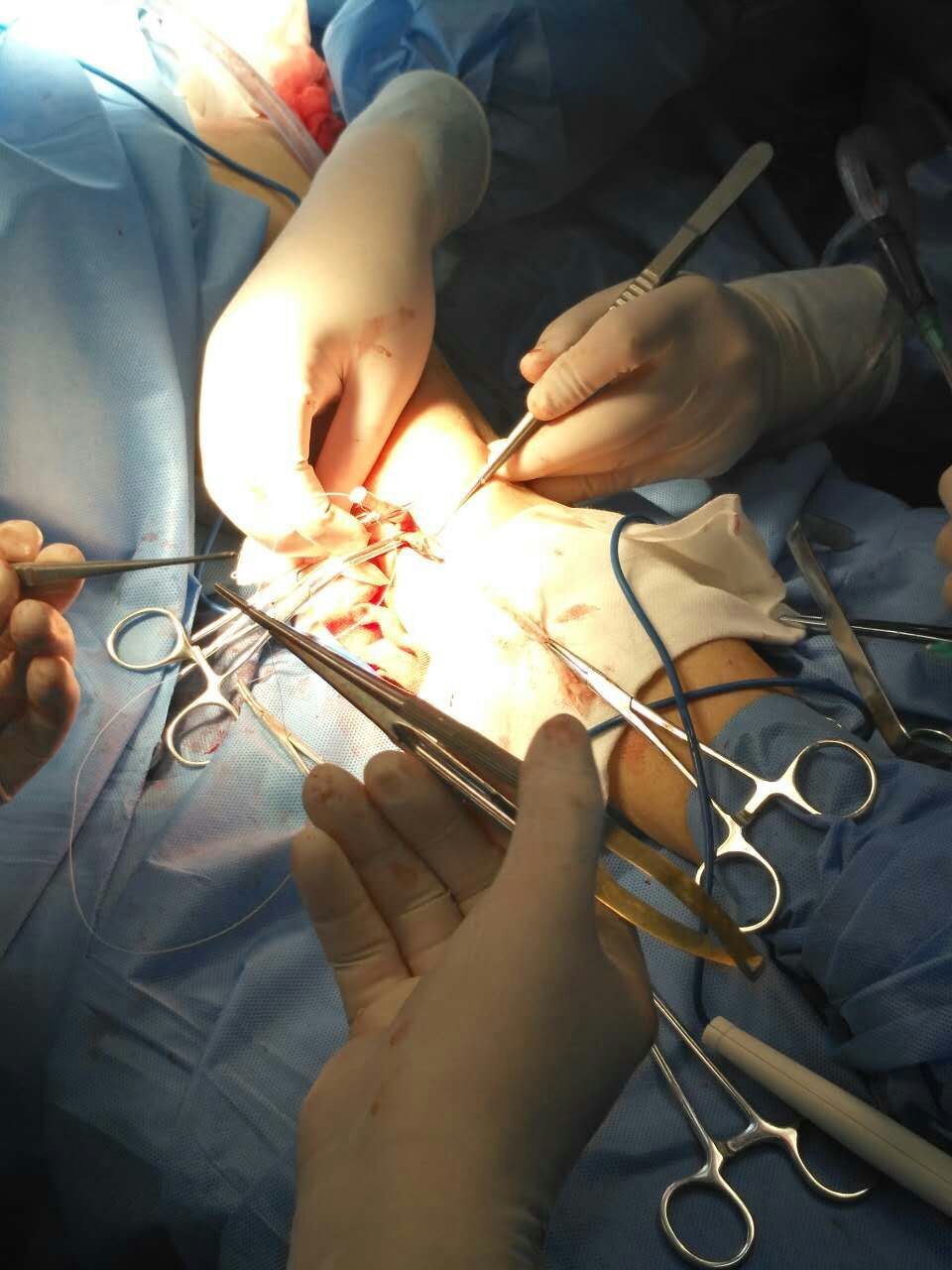 人工血管透析通路 - 好大夫在线