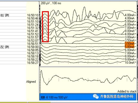 面瘫肌电图结果解读图片