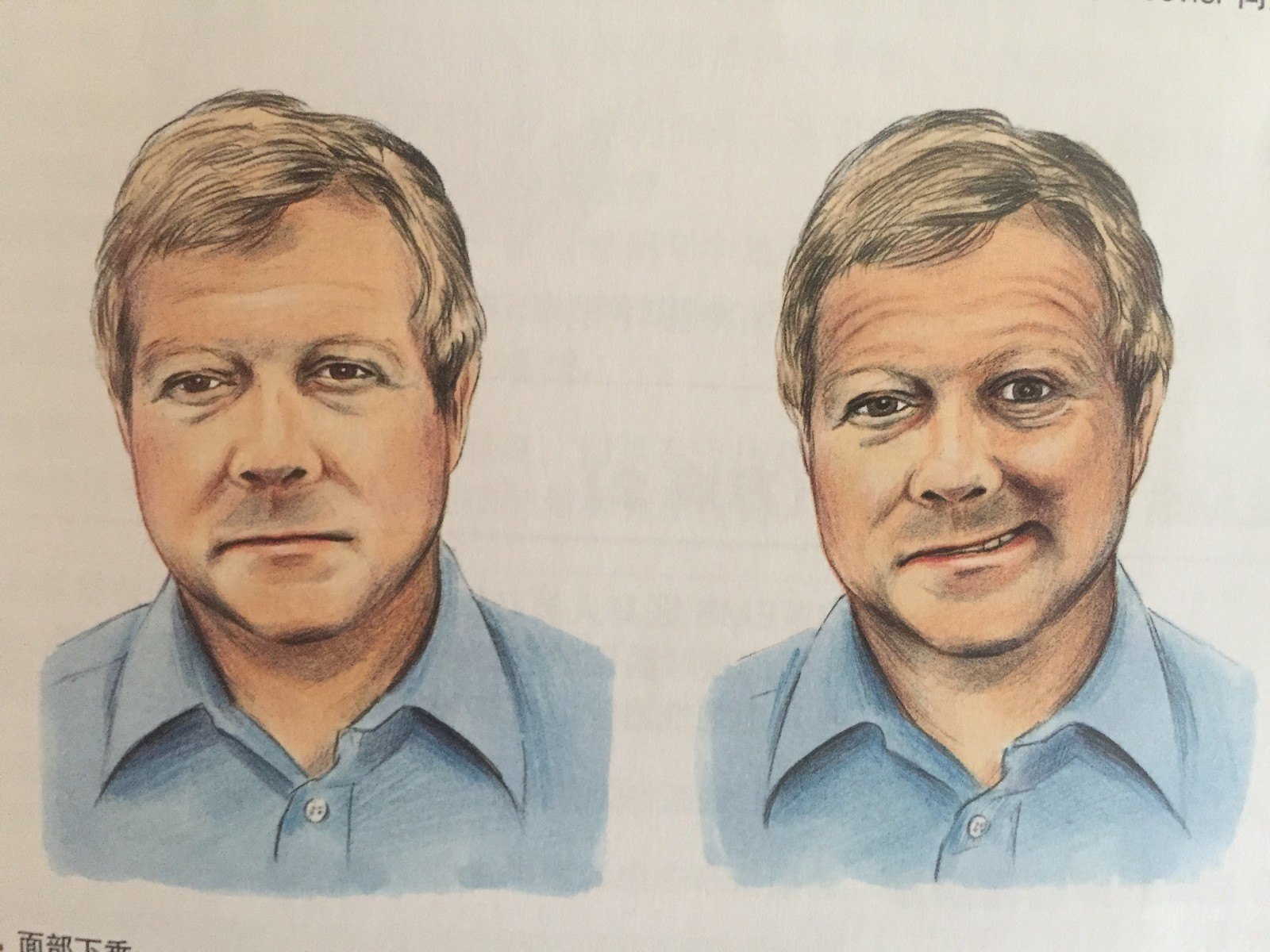 上肢偏移(患者双眼闭合,伸出双臂平举  秒钟,掌心向上)如果出现一只