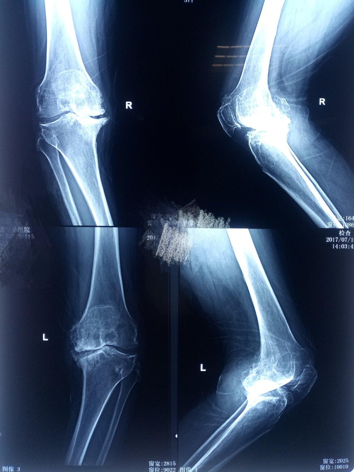 严重类风湿性关节炎