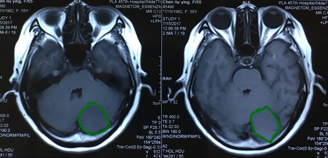 横窦-天幕脑膜瘤全切一例 - 好大夫在线