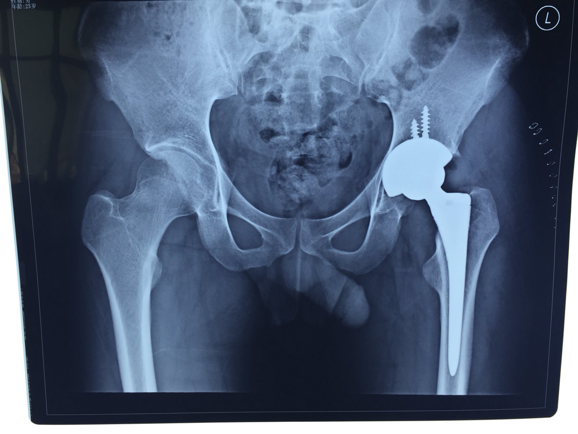 股骨颈骨折该选择怎样的治疗 内固定还是关节置换