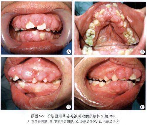 牙龈增生的症状图片