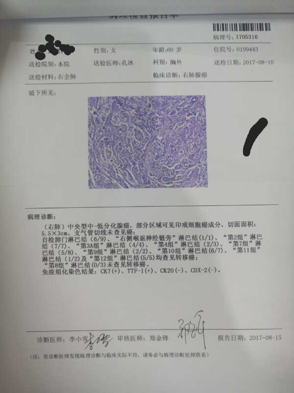 这例是6cm微创小切口的肺癌根治淋巴结清扫规范的病理报告单.