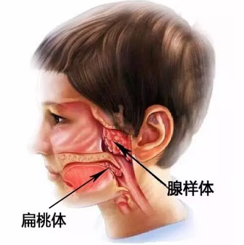 腭扁桃体和咽扁桃体图片