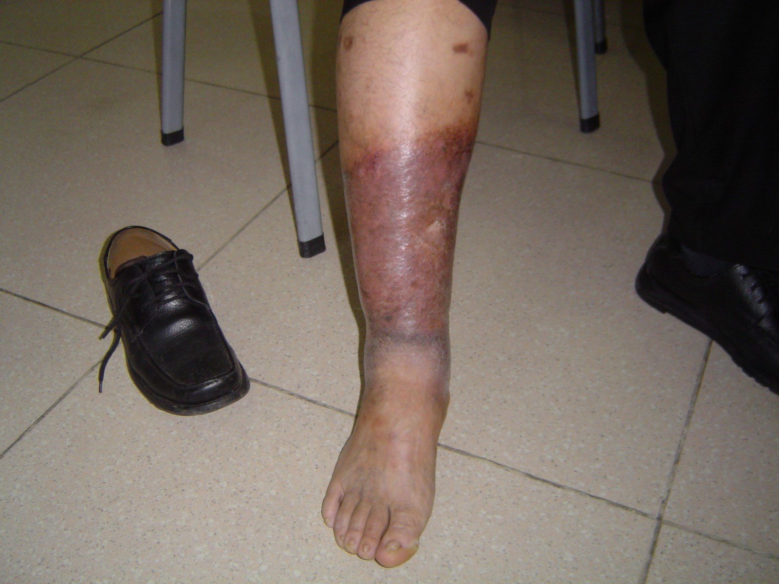 得了"老烂脚"怎么办?