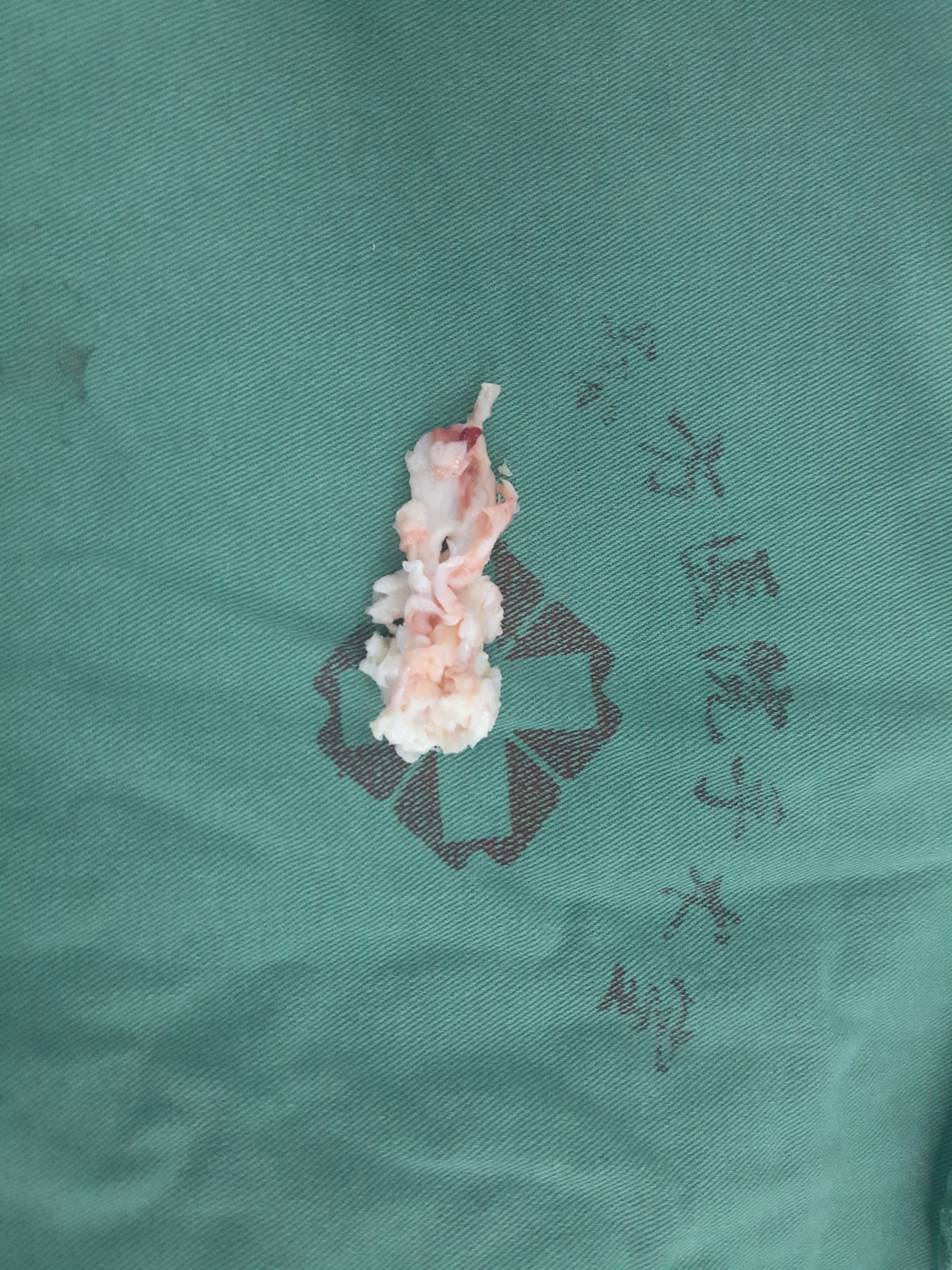 脊柱内镜翻修腰椎间盘突出症胶原酶溶核术后复