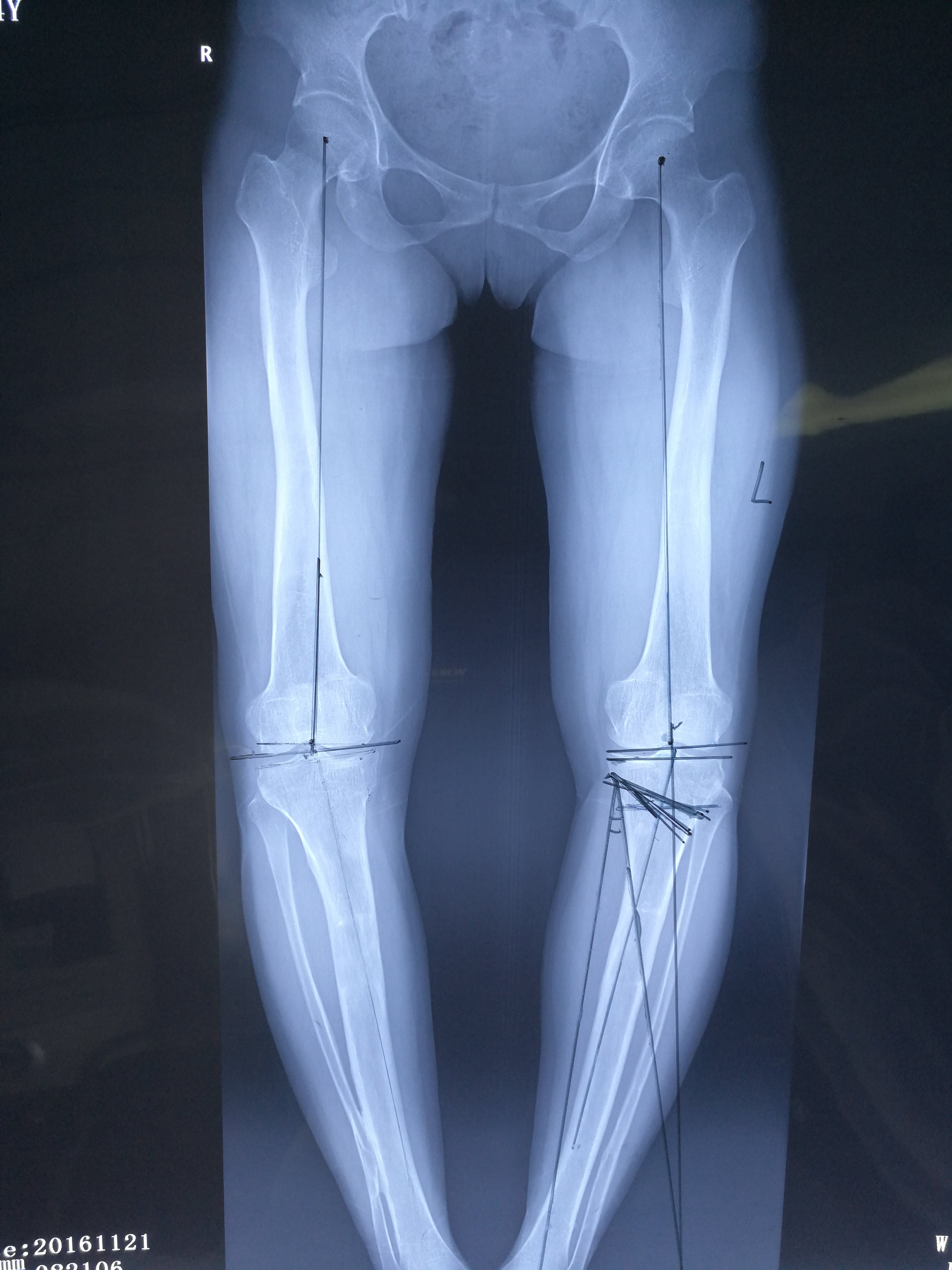 术前x片  术前计划 左胫骨上段外侧闭合截骨,右股骨髁上闭合截骨术后