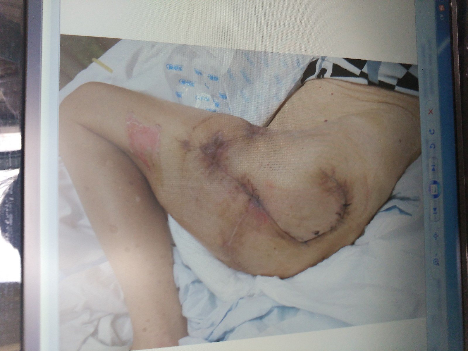 臀部多部位压疮外科手术修复的经典图片,供鉴赏,禁转载!