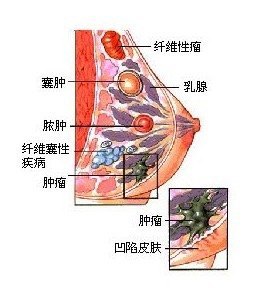 乳房卫星结节图片图片