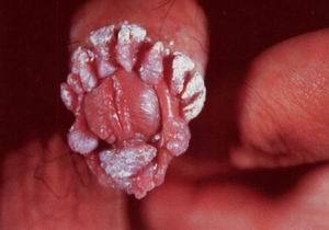 不是所有的外阴突起都是尖锐湿疣!