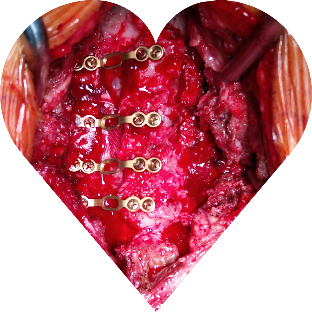 脊髓型颈椎病,要尽早手术 - 好大夫在线