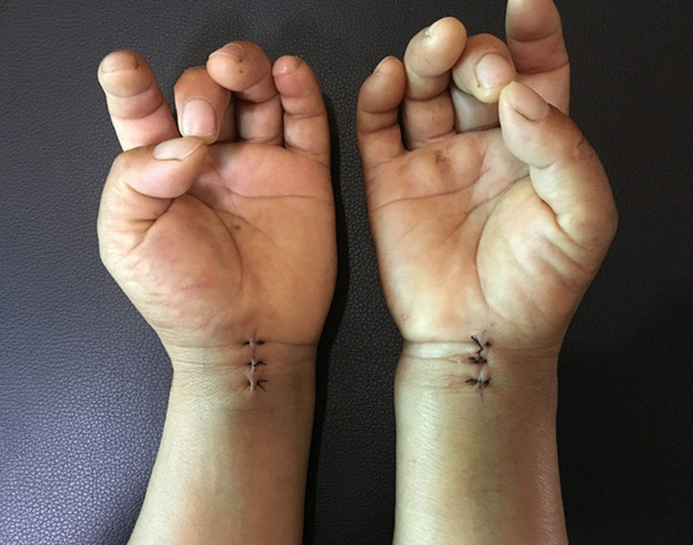 4 患者潘某,女性,52岁,腕管综合征多年,双侧鱼际肌萎缩,手指麻木无力