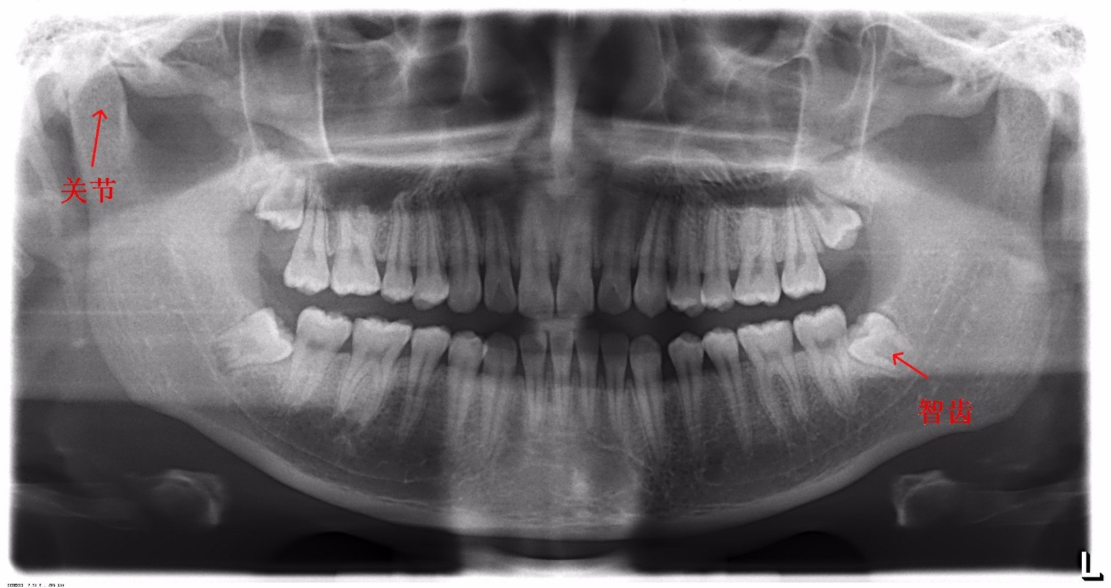 正常的牙齿侧面x片图片